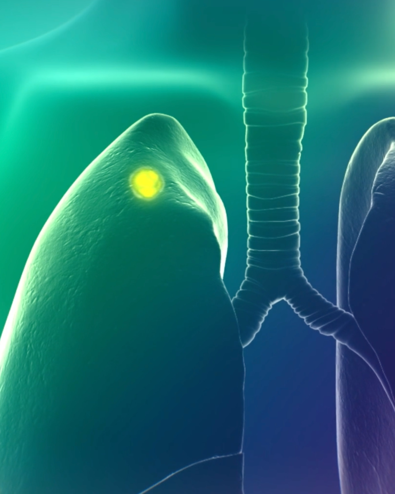 fda-approves-drug-for-lung-cancer-surgery